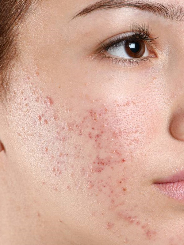 Acne Skin