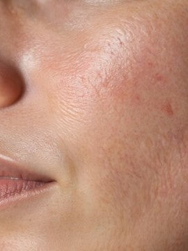 Anti Aging