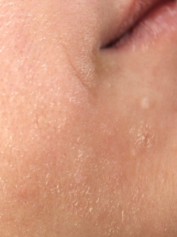 Dry Skin