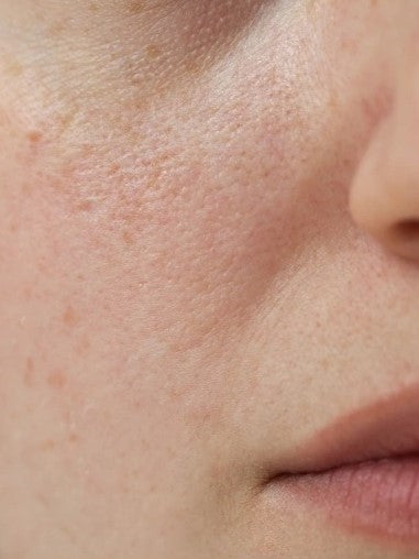 Dull Skin