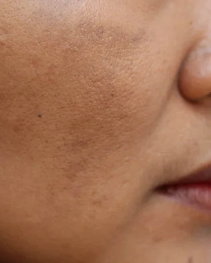 Uneven Skin