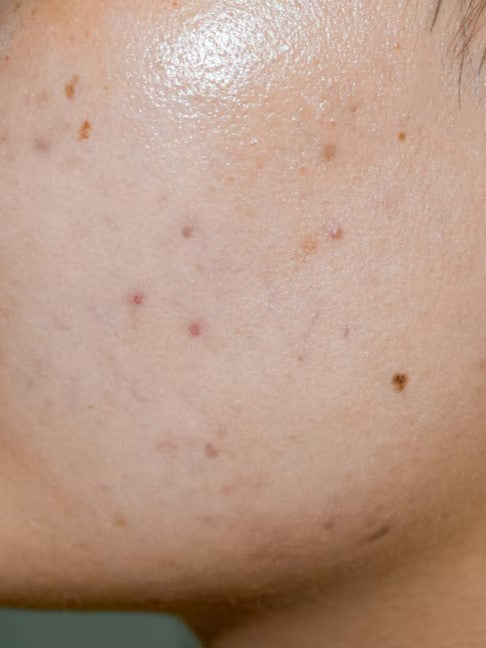 Dark Spots